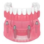 implant dentures 