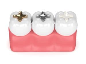 3d render of teeth with gold, amalgam and composite inlay dental filling over white background