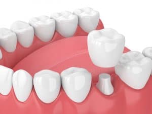 cedar west dental crown