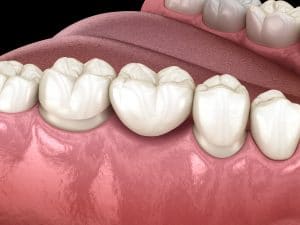 cedar west dental bridge