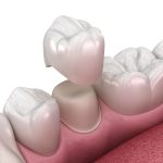 richfield dental crowns