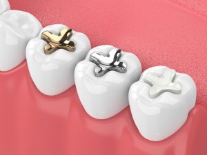 richfield dental fillings