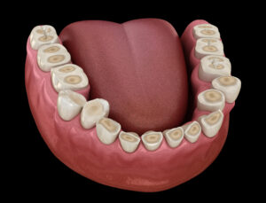 richfield bruxism