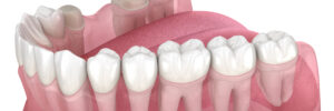 richfield dental bridges