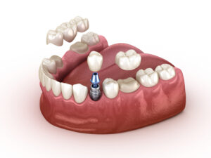 richfield dental crown