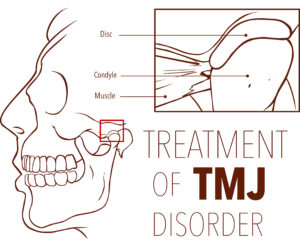 richfield tmj treatment