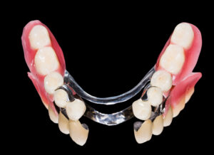 richfield partial dentures