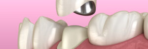 richfield dental crowns
