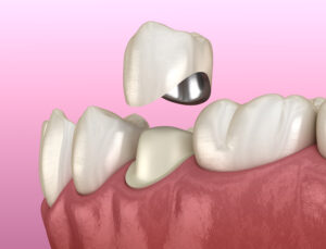 richfield dental crowns