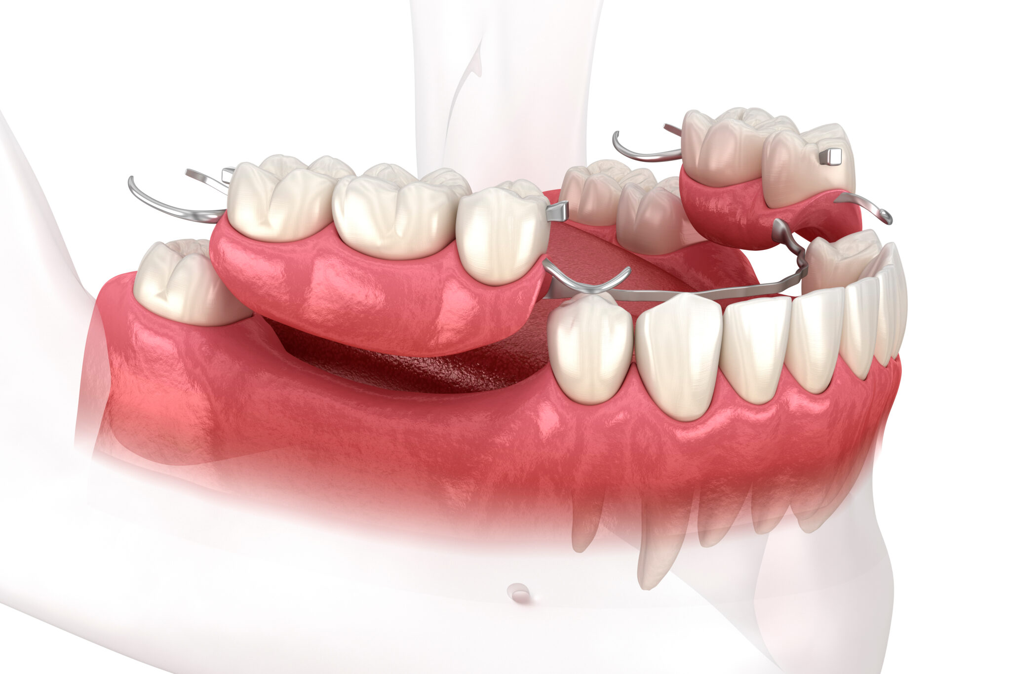 Clean Partial Dentures Naturally