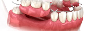 richfield partial dentures