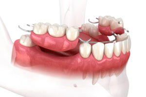 richfield partial dentures