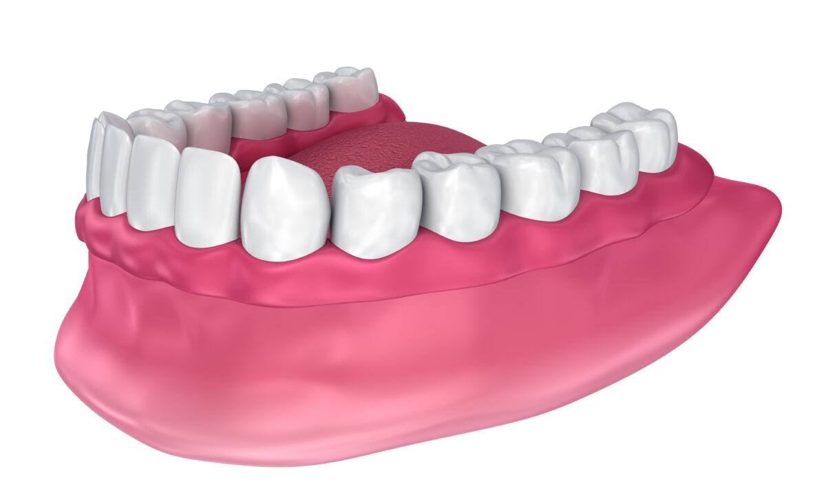 A Full Denture Provides A Complete Smile Richfield, MN