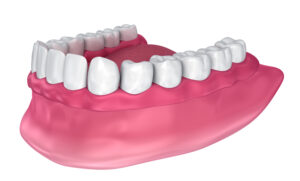 richfield full dentures