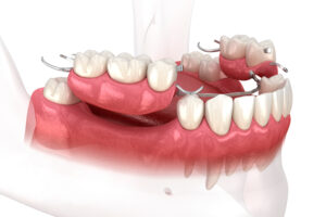 Cedarwest missing teeth