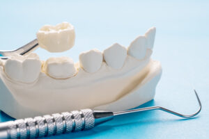 Richfield, MN, dentist offers dental crowns 