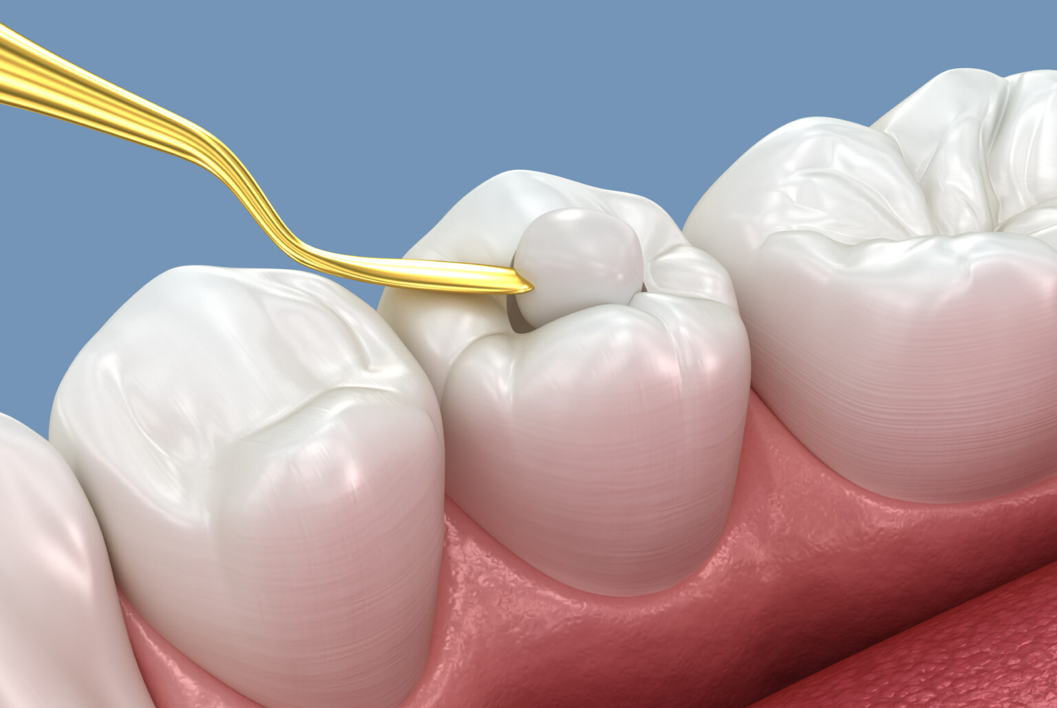 Treating Your Cavities With Tooth Fillings | Richfield, MN