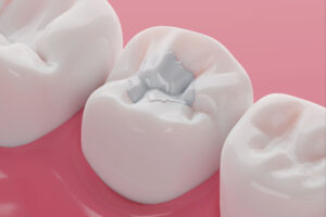 richfield fillings