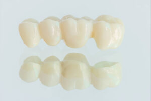 richfield dental bridge
